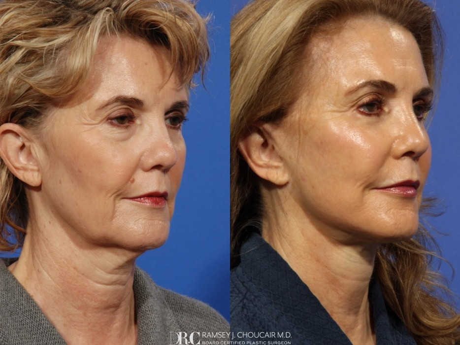 Eyes Before And After Dr Ramsey Choucair 3221