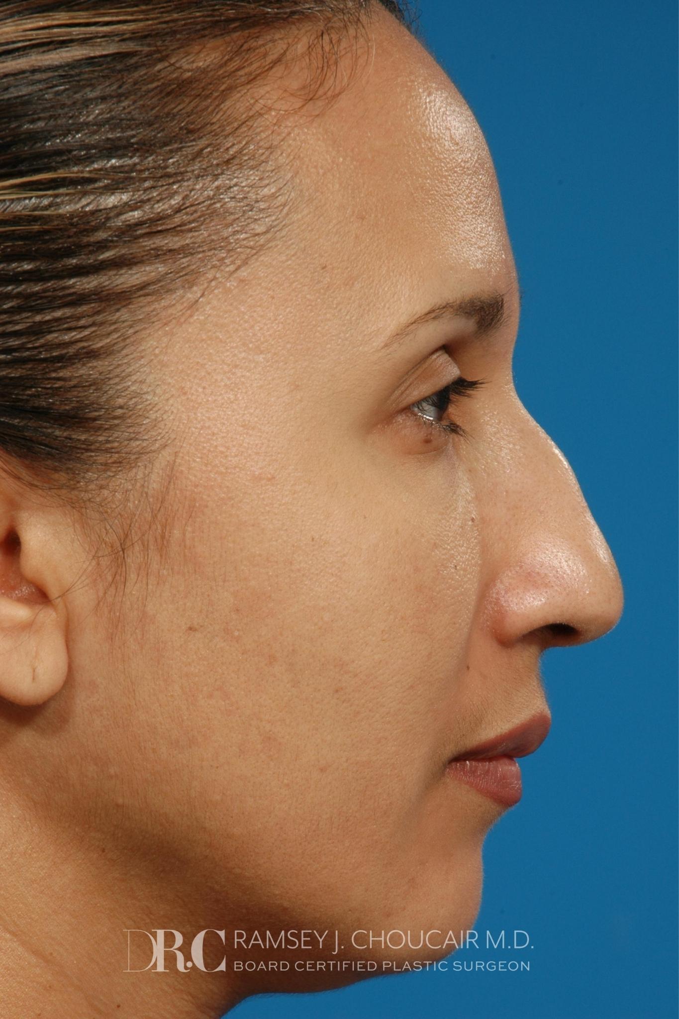 Face Patient 6 Dr Ramsey Choucair 7420